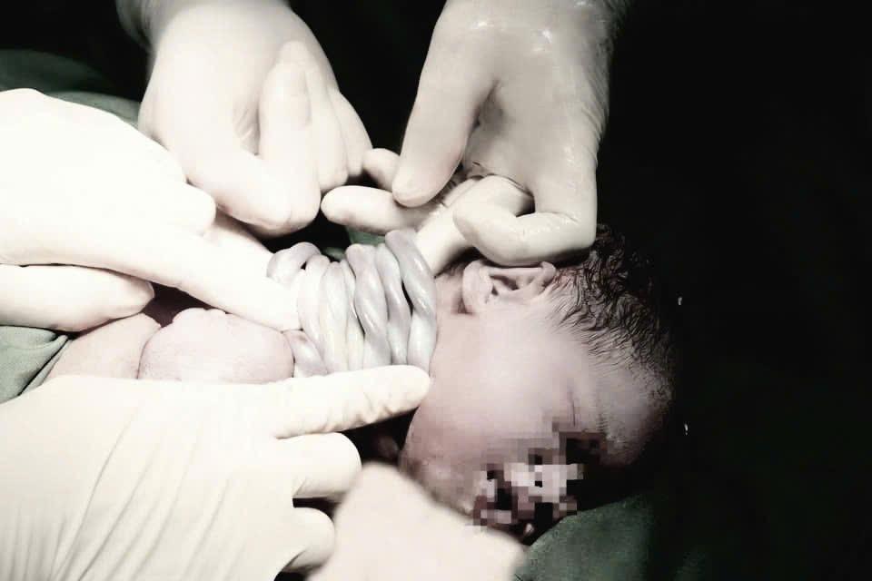 Cực hiếm: Bé gái vượt ngàn chông gai chào đời với 9 vòng dây rốn quấn cổ-1